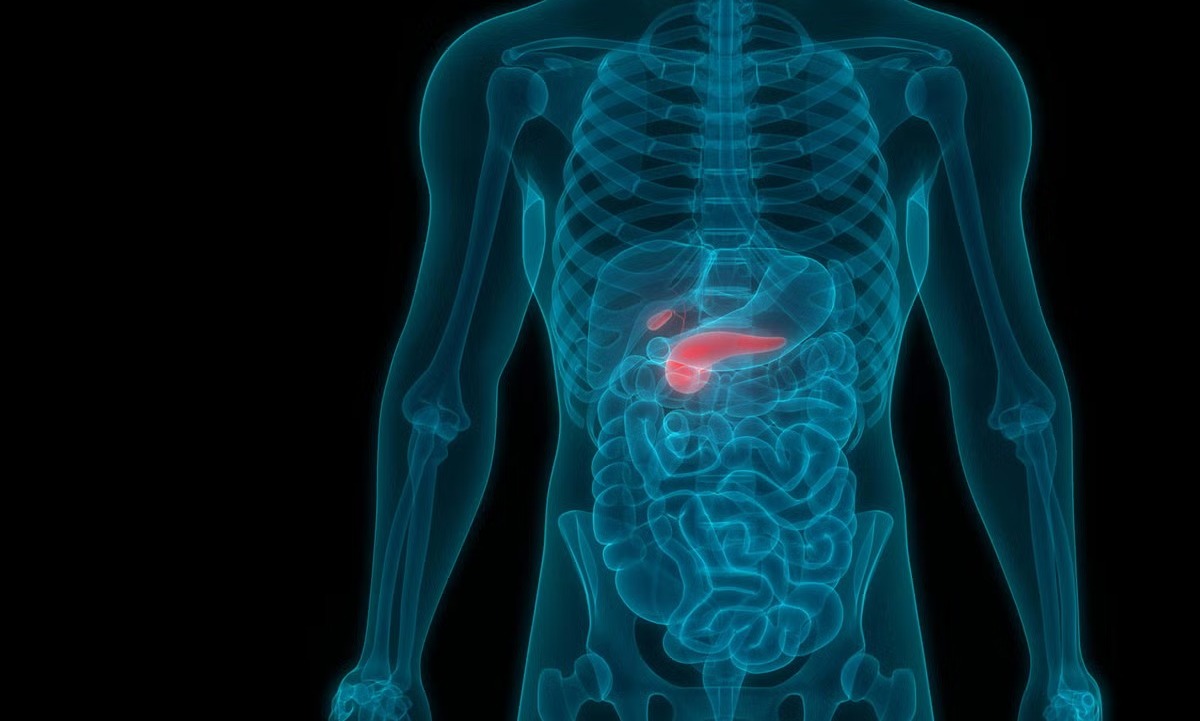 Rising obesity rates could lead to pancreatic cancer